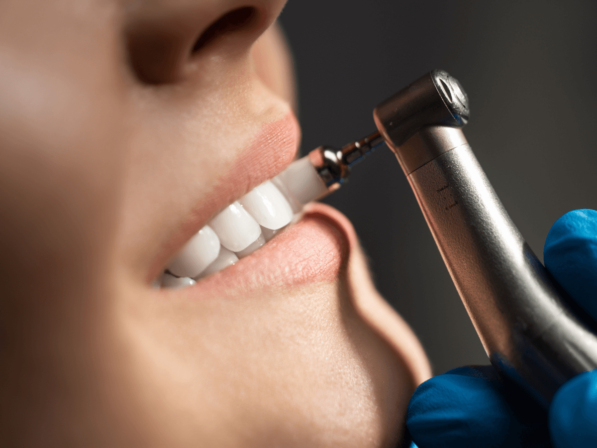 درمان تارتار دندان | نخ دندان مینا