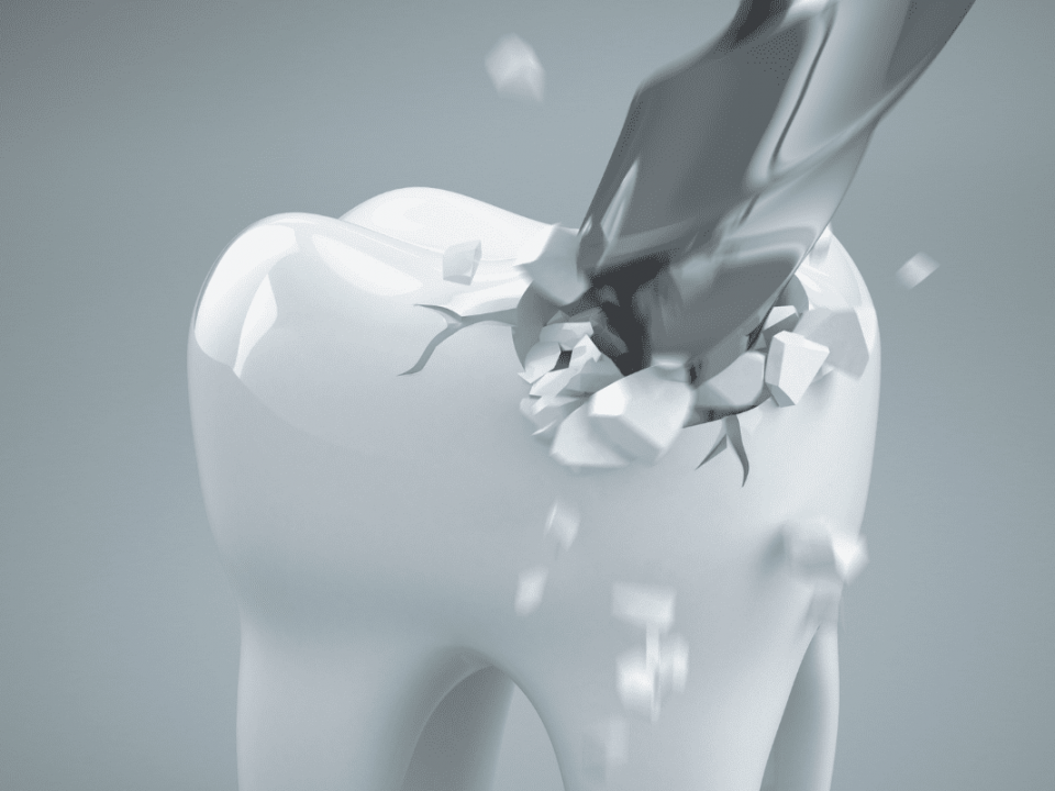 شناخت 11 روش ترمیم شکستگی دندان | شرکت نخ دندان مینا