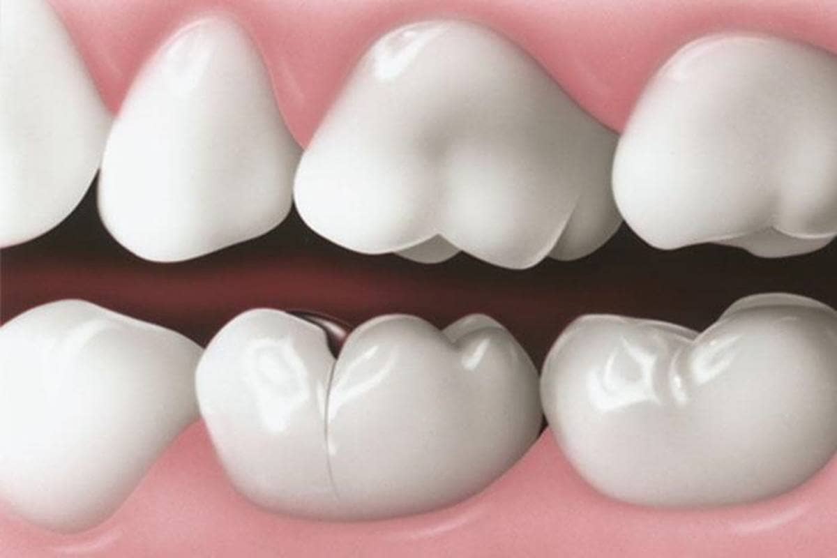 اسپلینت دندان | شرکت نخ دندان مینا