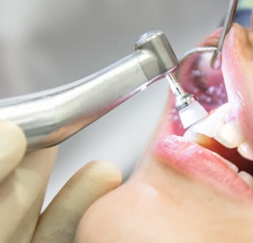 معرفی کامل بروساژ دندان | نخ دندان مینا