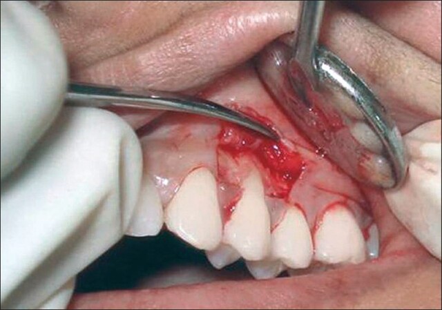 جراحی اندودنتیک چیست | نخ دندان مینا