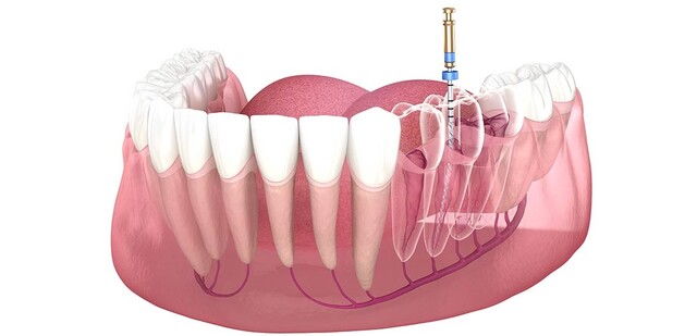 روش‌های جراحی اندودنتیک چیست؟ | نخ دندان مینا