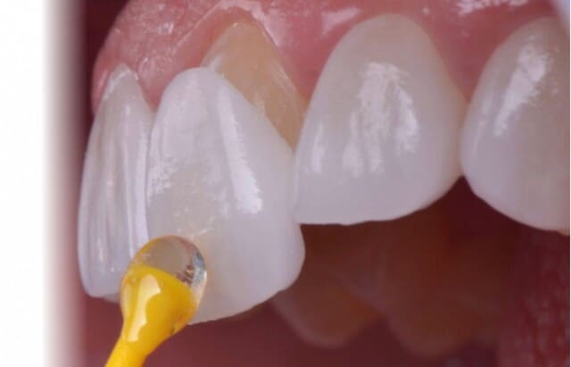 معایب لومینیرز دندان چیست  | نخ دندان مینا
