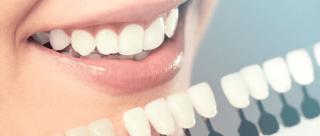 لومینیرز دندان بهتر است یا لمینت؟ | نخ دندان مینا