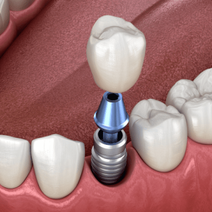 7 دلیلی که باعث لق شدن ایمپلنت دندان می شود + روش‌های جلوگیری و درمان آن | نخ دندان مینا