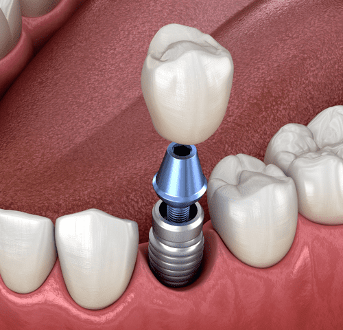 7 دلیلی که باعث لق شدن ایمپلنت دندان می شود + روش‌های جلوگیری و درمان آن | نخ دندان مینا