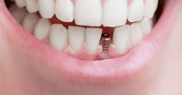 روش‌های درمان لق شدن ایمپلنت دندان چیست؟ | نخ دندان مینا