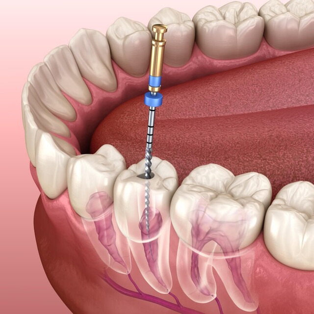 کشیدن دندان یا درمان ریشه در چه مواقعی نیاز است؟  | نخ دندان مینا