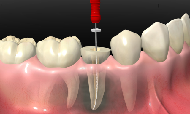 نتیجه گیری از مقایسه کشیدن دندان یا درمان ریشه | نخ دندان مینا