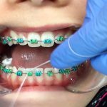 روش صحیح استفاده از نخ دندان ارتودنسی