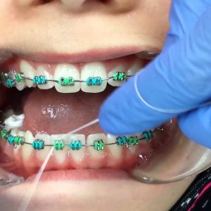 استفاده از نخ دندان ارتودنسی | نخ دندان مینا