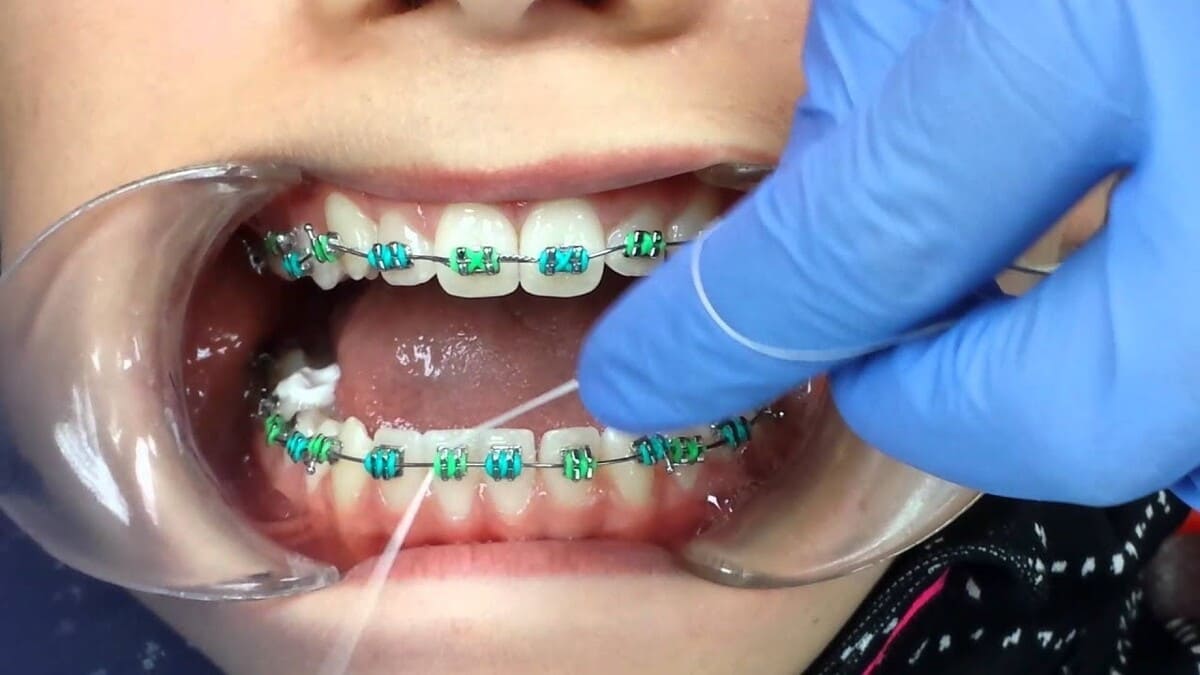 نخ دندان ارتودنسی | نخ دندان مینا